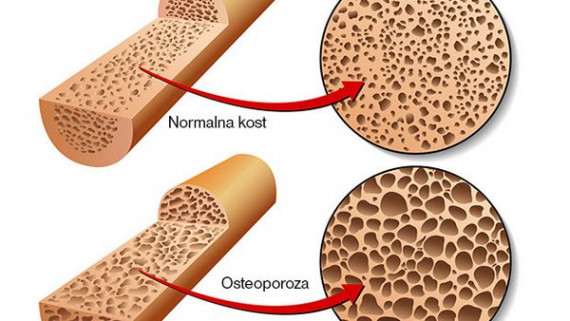 Osteoporoza