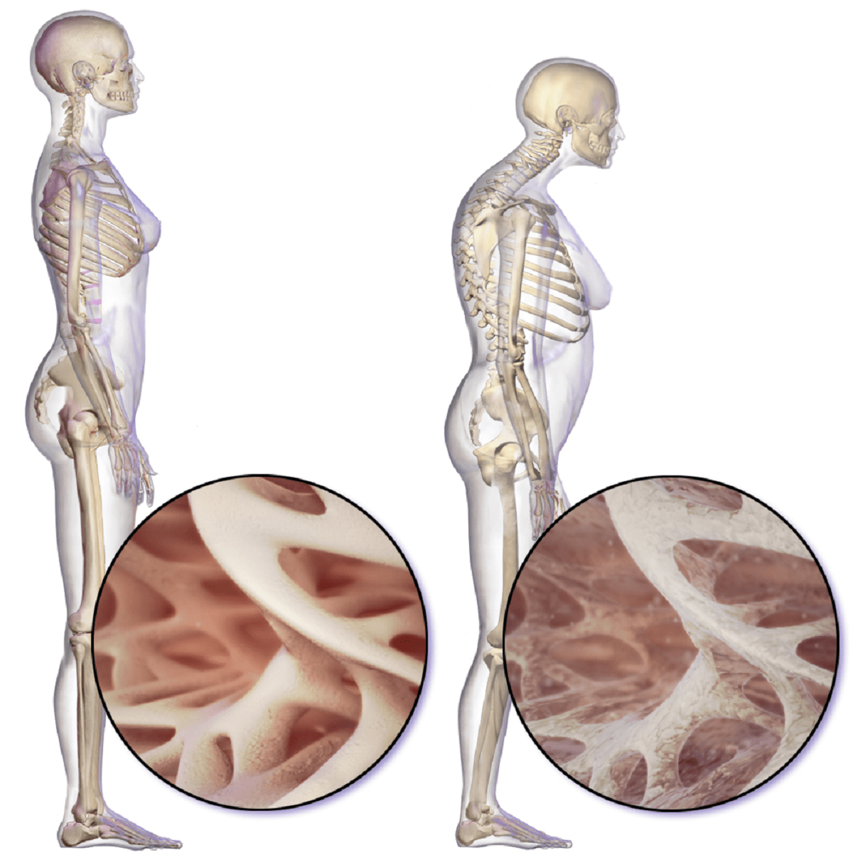 Levo je približana zdrava gobasta kost, desno pa kost, ki ima osteoporozo