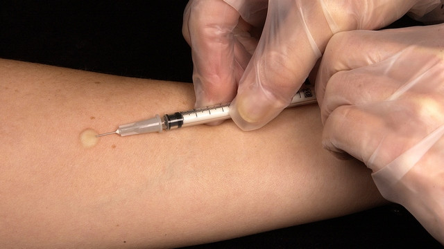 Tuberkulinski kožni test Tuberkulinski kožni test (foto: Wikipedia)